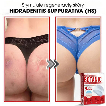 BotaniClear™ – Plaster z mikronakłuciami na zmiany skórne - 1+1 GRATIS