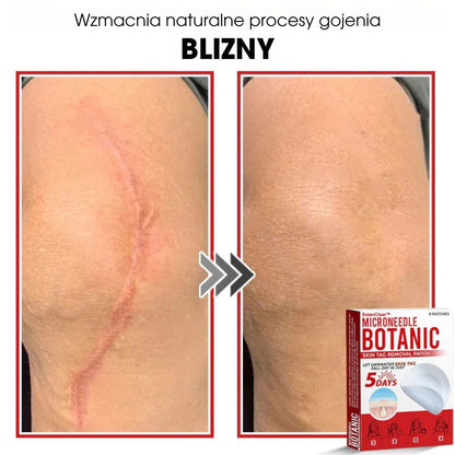 BotaniClear™ – Plaster z mikronakłuciami na zmiany skórne - 1+1 GRATIS