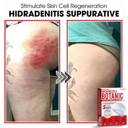 BotaniClear™ – Plaster z mikronakłuciami na zmiany skórne - 1+1 GRATIS